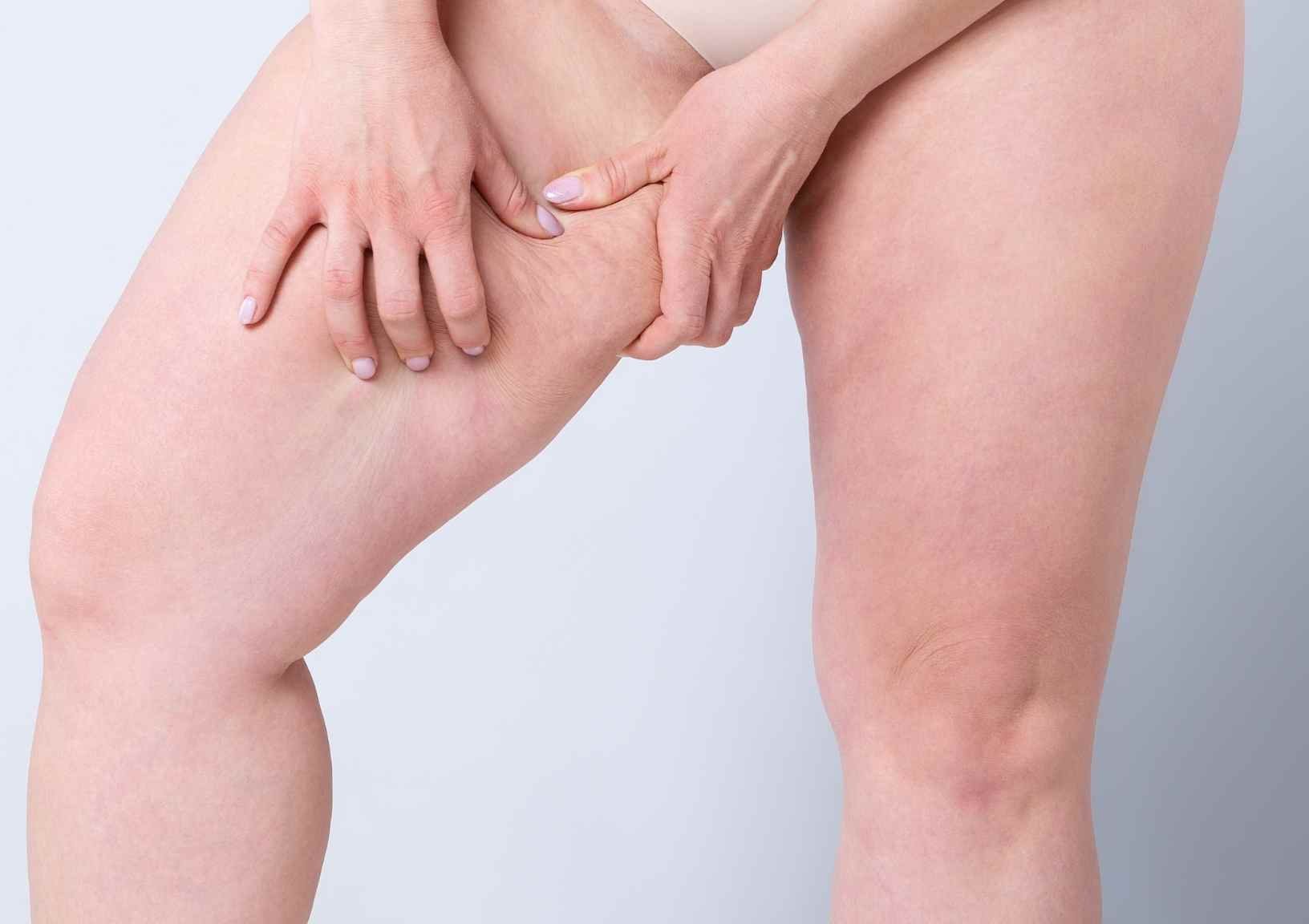 How To Prevent Inner Thigh Chafing: Female Relief Tips
