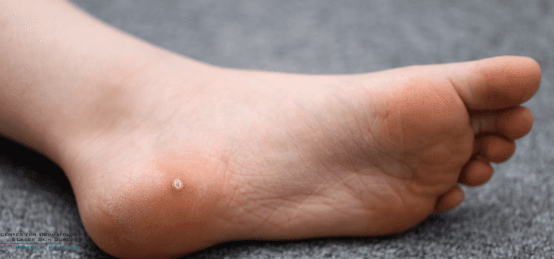 Plantar Warts Can Be Stubborn, But There Are Several Treatment Options to Try