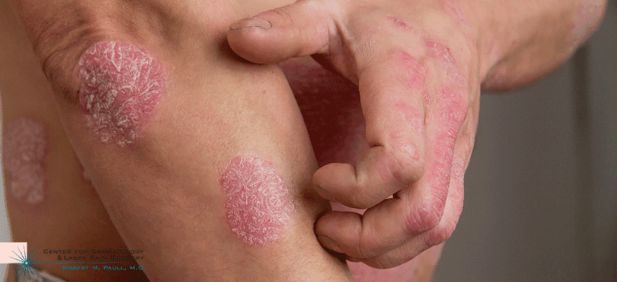 Everything You Need to Know About Atopic Dermatitis