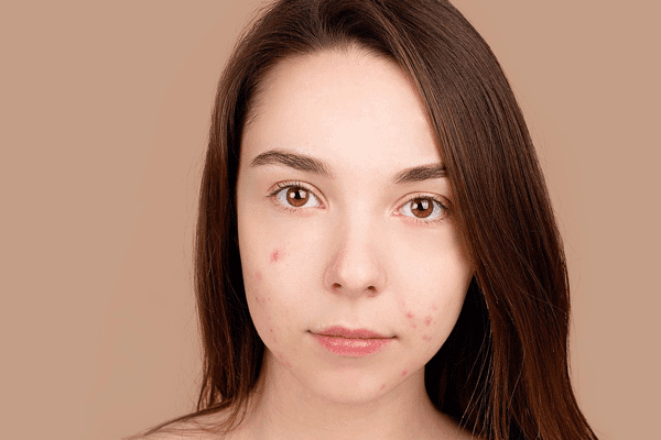 Hidradenitis suppurativa Can Look Like Acne, But It’s Much More Serious
