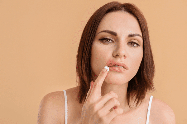 How to Treat a Cold Sore