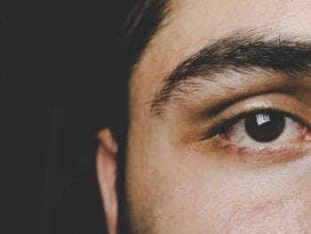 Crow’s Feet and Dark Circles Are on Everyone’s Radar. Preorbital Veins Are Not, But They Should Be