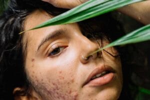 Frustrated By Adult Acne? It’s Time to Revamp Your Skincare Routine