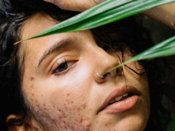 Frustrated By Adult Acne? It’s Time to Revamp Your Skincare Routine