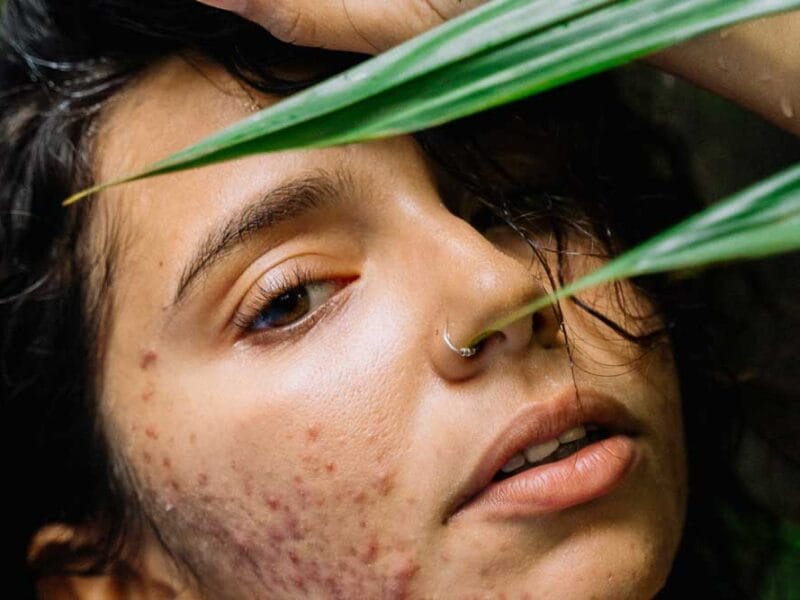 Frustrated By Adult Acne? It’s Time to Revamp Your Skincare Routine