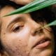 Frustrated By Adult Acne? It’s Time to Revamp Your Skincare Routine