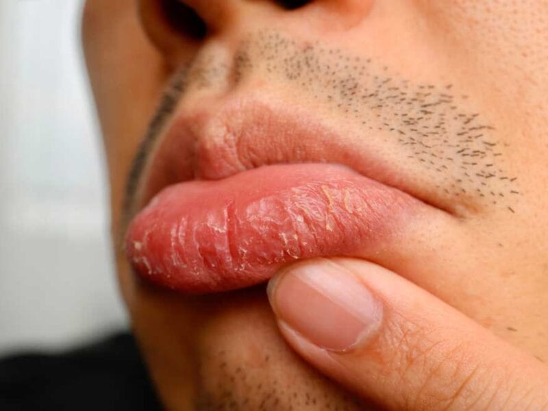 You Don’t Have to Suffer with Chapped Lips This Winter