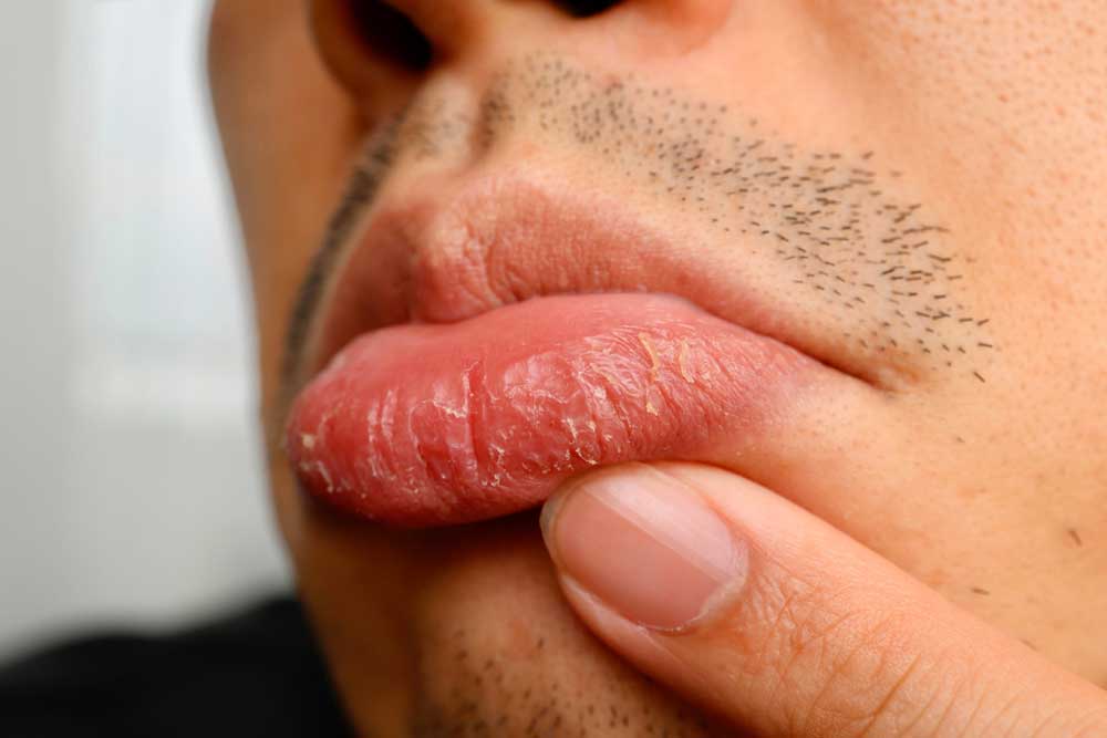 You Don’t Have to Suffer with Chapped Lips This Winter