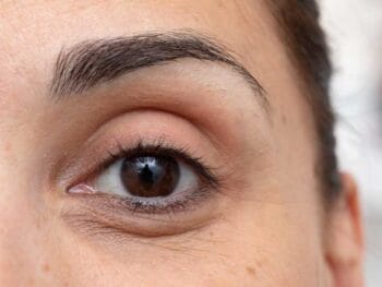 Skincare Products Are Mostly Ineffective at Brightening Dark Circles, but a Dermatologist Can Help