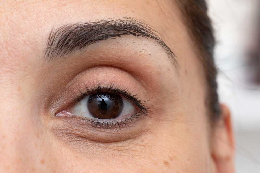 Skincare Products Are Mostly Ineffective at Brightening Dark Circles, but a Dermatologist Can Help