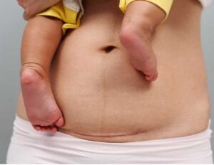 When To Seek Help When You’re Concerned About Your C-Section Scar