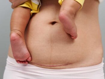 When To Seek Help When You’re Concerned About Your C-Section Scar
