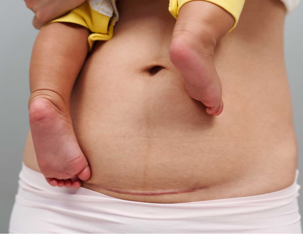 When To Seek Help When You’re Concerned About Your C-Section Scar