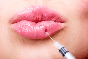 Everything You Need to Know About Filler Migration