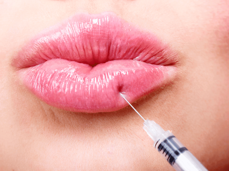 Everything You Need to Know About Filler Migration