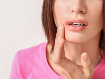 Is It OK to Hide a Cold Sore with Makeup?