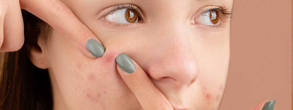 If You Must Pop a Pimple, This Is How You Should Do It