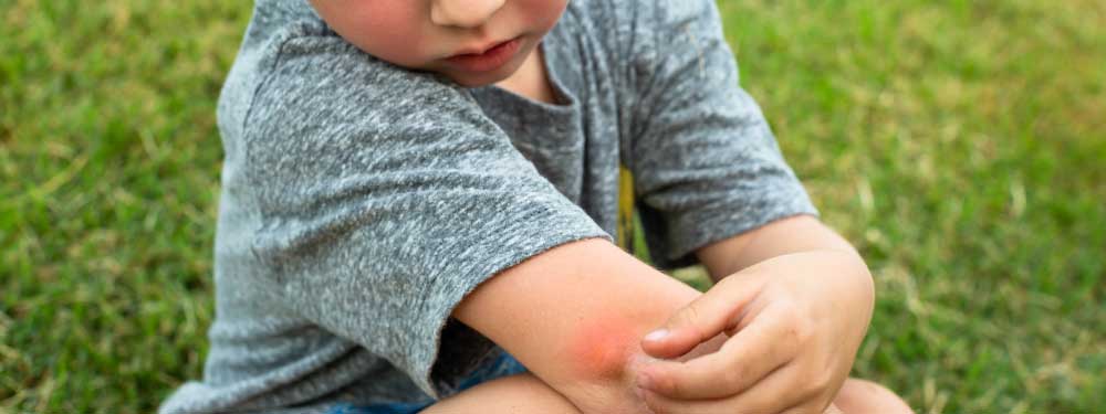 How To Relieve the Itch from A Bug Bite