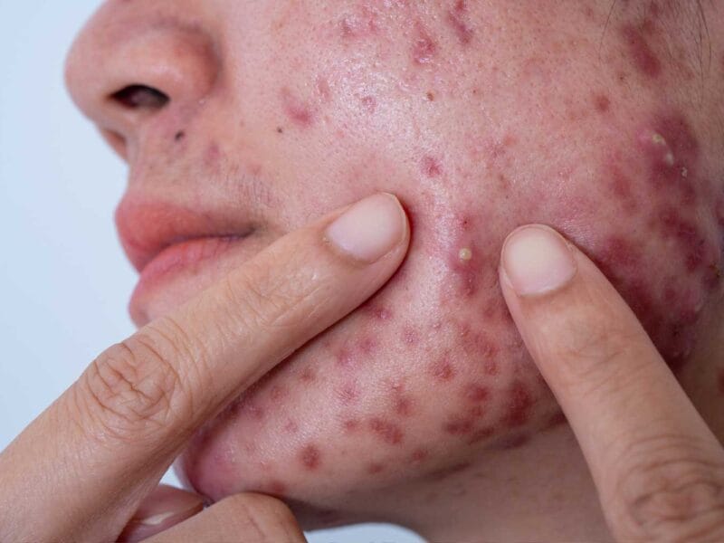 If You Must Pop a Pimple, This Is How You Should Do It