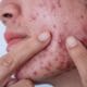 If You Must Pop a Pimple, This Is How You Should Do It