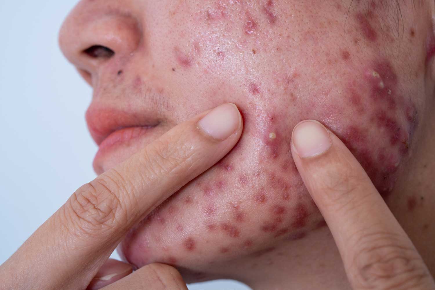 If You Must Pop a Pimple, This Is How You Should Do It