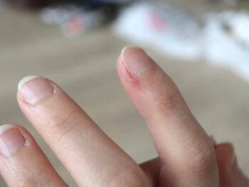 What To Do If You Get a Hangnail, And How to Prevent Them in The First Place