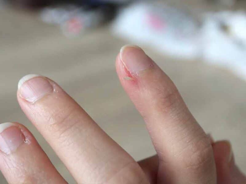 What To Do If You Get a Hangnail, And How to Prevent Them in The First Place