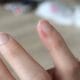 What To Do If You Get a Hangnail, And How to Prevent Them in The First Place
