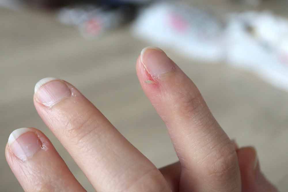 What To Do If You Get a Hangnail, And How to Prevent Them in The First Place